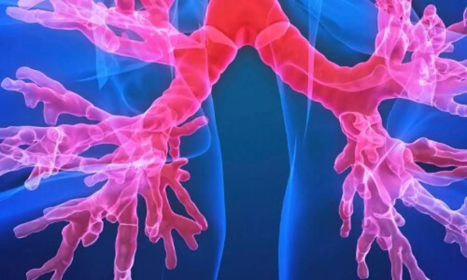 Hypertonic Saline and Carbocisteine Fail to Reduce Pulmonary Exacerbations in Bronchiectasis: Study