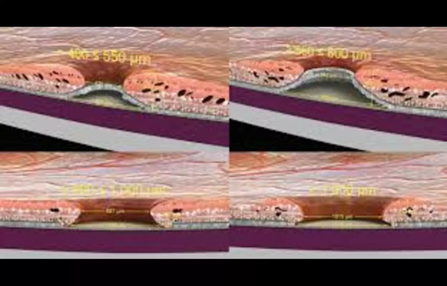 Dyslipidemia Linked to Delayed Macular Hole Closure After Surgery: Study