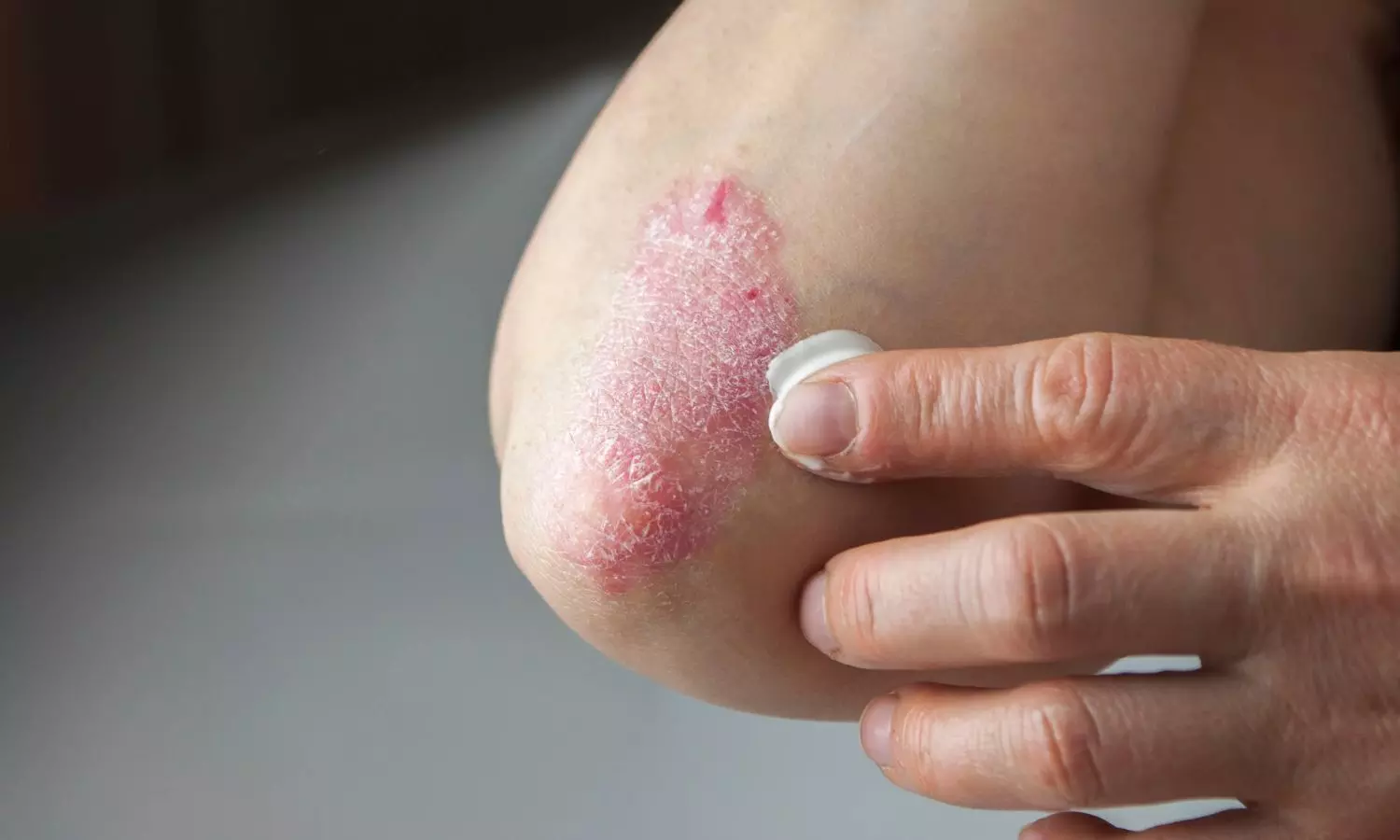 Patients with coexisting psoriasis and diabetes face elevated all-cause mortality risk: Study