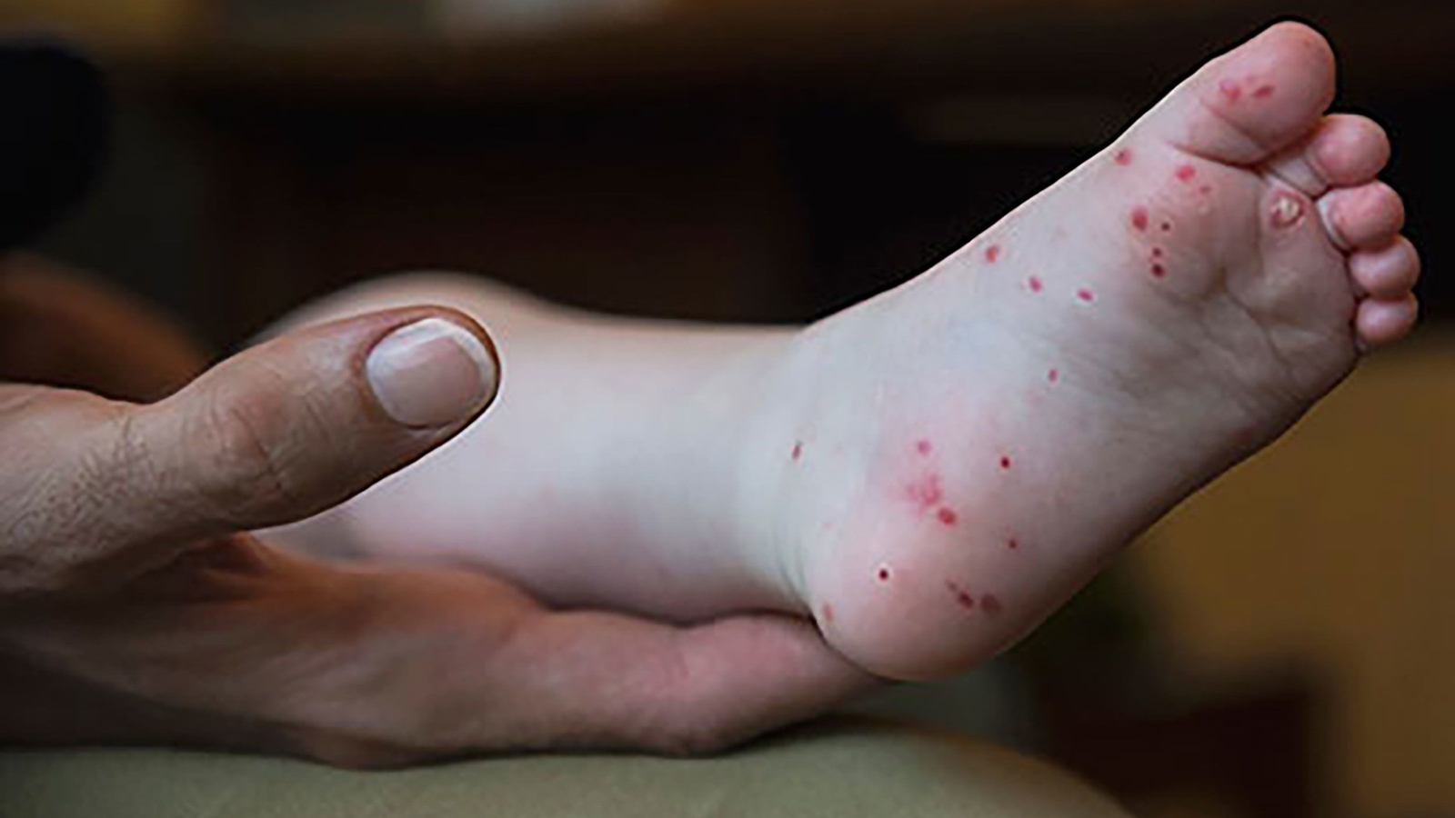 Hand, foot and mouth disease on rise in certain areas: Doctor explains symptoms, treatment