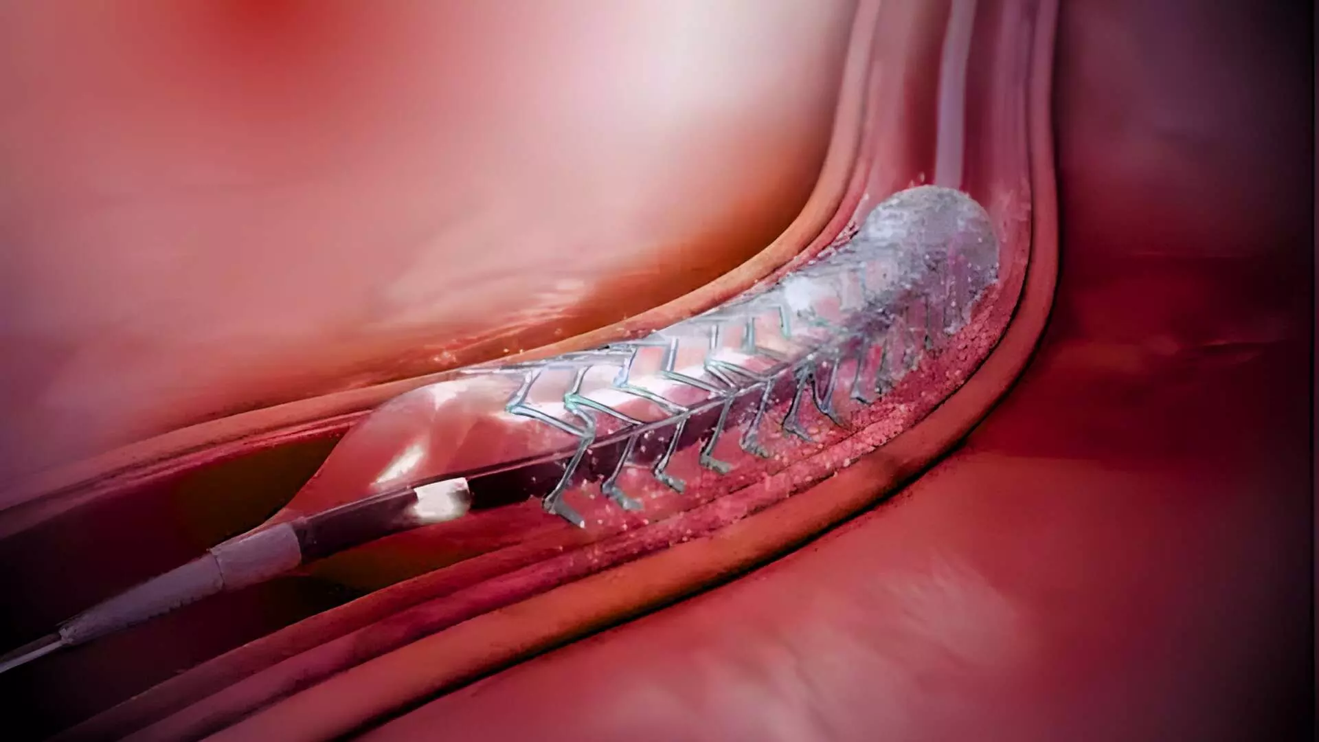TCT 2025: ShortCUT Trial Compares Cutting Balloon Angioplasty and Intravascular Lithotripsy (IVL) for Calcified Coronary Artery Disease