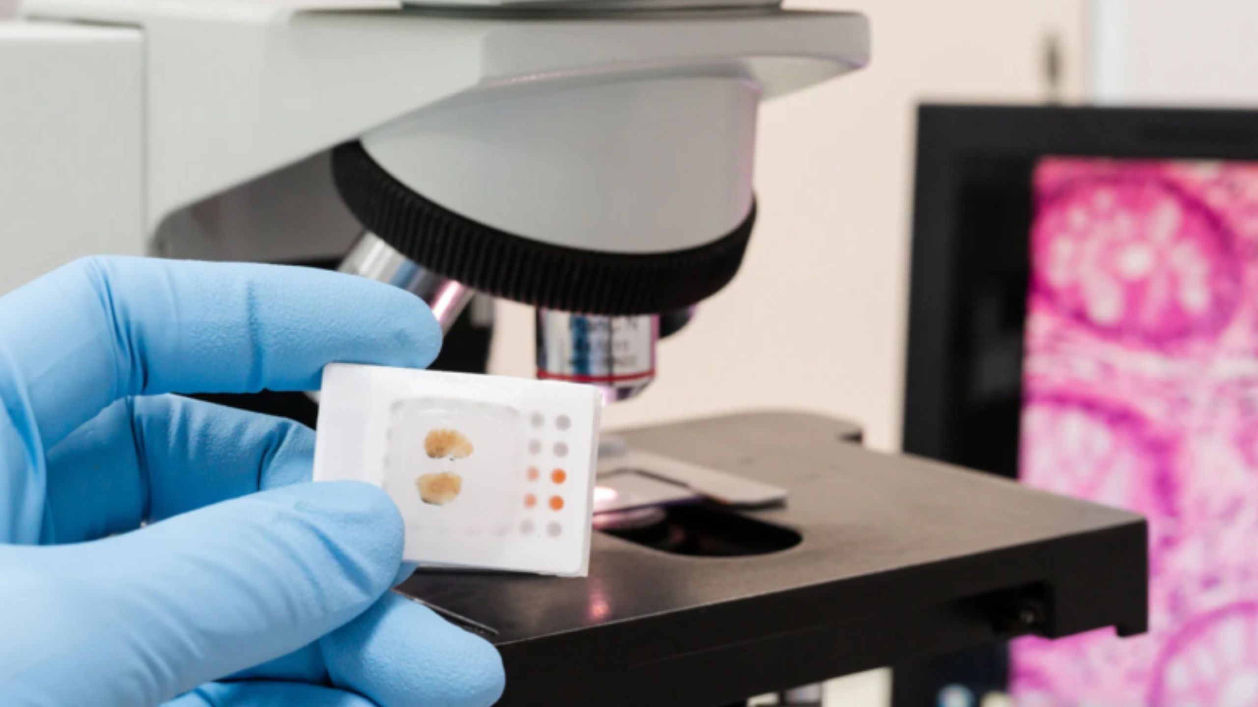 Can AI Help Prostate Cancer Patients? Oxford Study Attempt to Determine Its Benefits