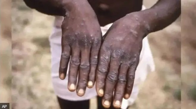 Kenya reports first Mpox case in Garissa as health worker tests positive