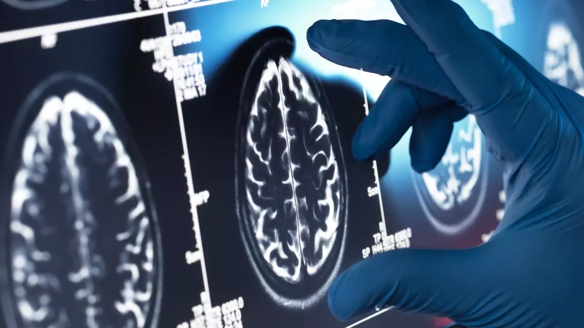 Scientists discover simple daily habit that could help slow down Alzheimer’s disease progression