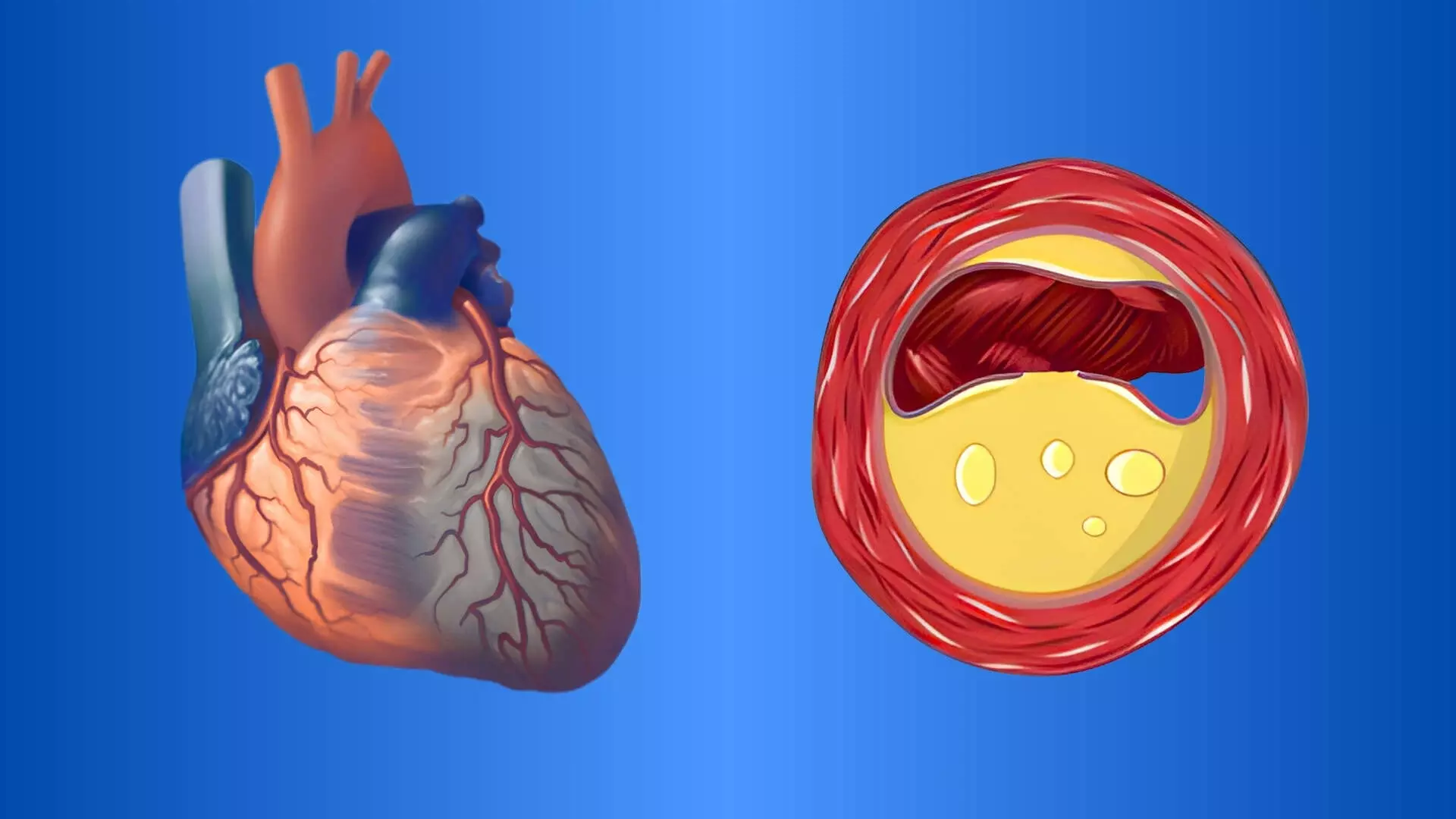No Benefit of Low-Dose Intracoronary Alteplase During Primary PCI in STEMI With High Thrombus Burden: STRIVE Trial, TCT 2025