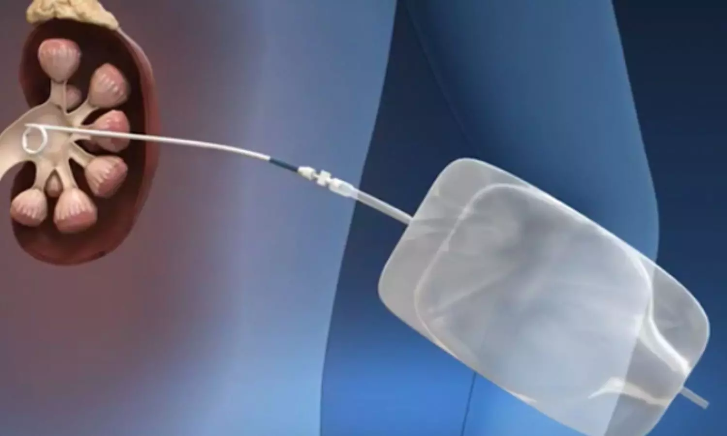 Vacuum-Assisted Mini-PCNL Cuts Infection Risk in Low-Risk Kidney Stone Patients: Study