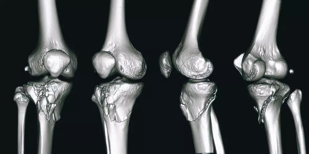 Medial Opening Wedge High Tibial Osteotomy Shows Superior Outcomes in Knee OA: Study