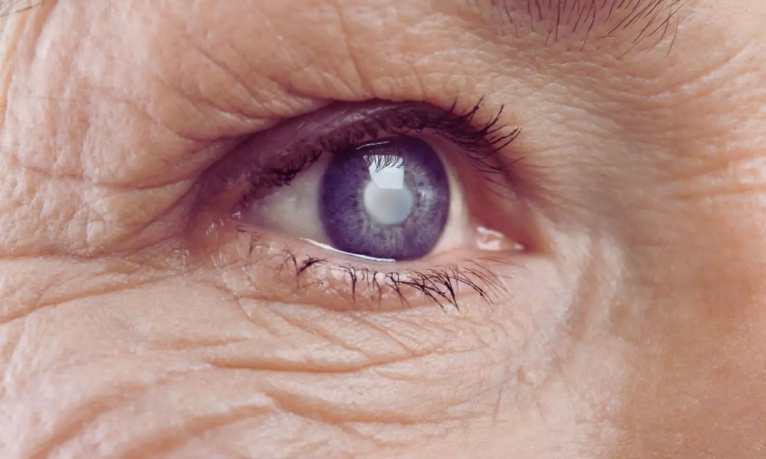 Age-Related Eye Diseases Raise Risk of Heart Disease–Depression Combo, Long-Term Study Shows