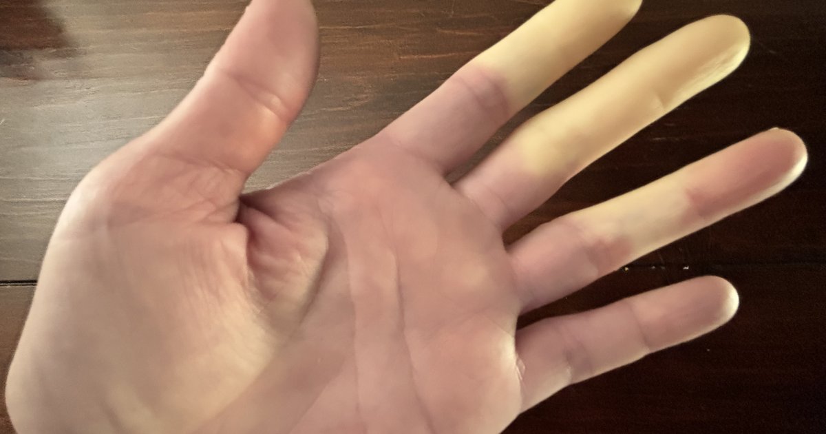 Raynaud's syndrome can be painful and annoying, but it's usually not dangerous