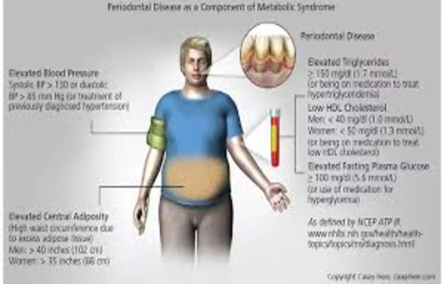 Obesity Linked to Increased Severity of Periodontitis, suggests study