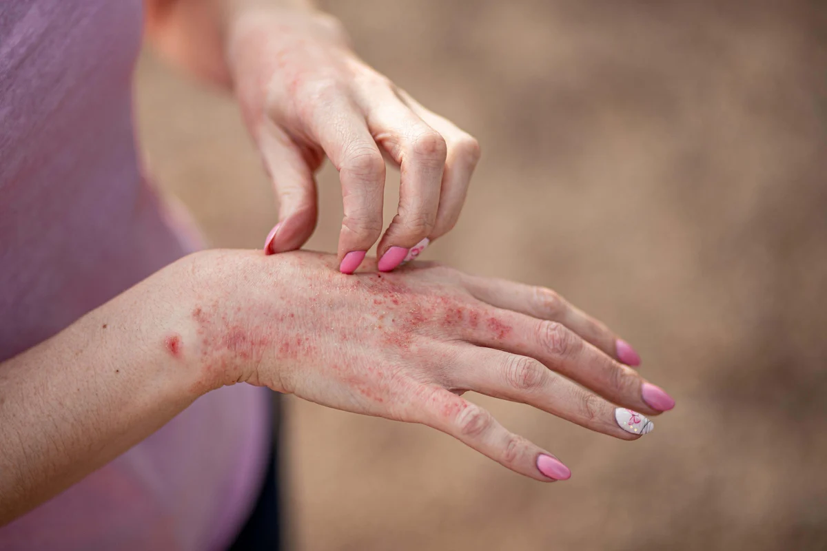 NHS rollout of new eczema cream could benefit more than 62,000 people in England
