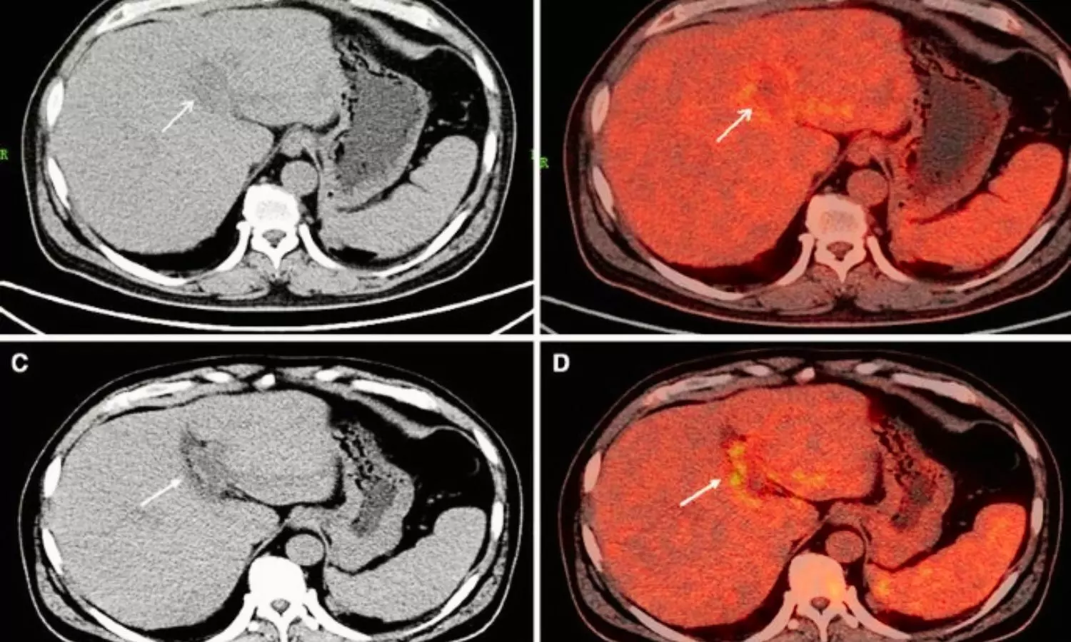 Engineered Stone silicosis associated with strong metabolic activity and extrathoracic lymphadenopathies: Study