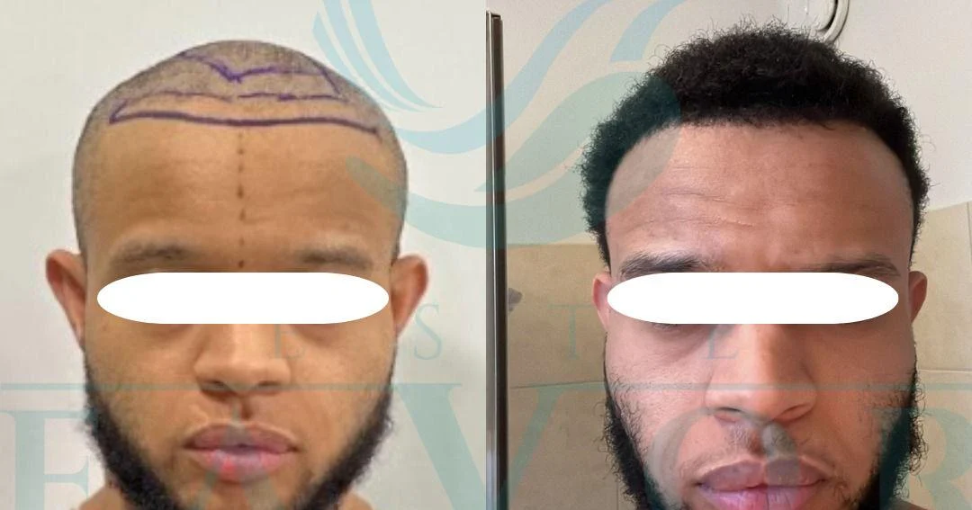 Top 5 Best Afro Hair Transplant Clinics in Turkey