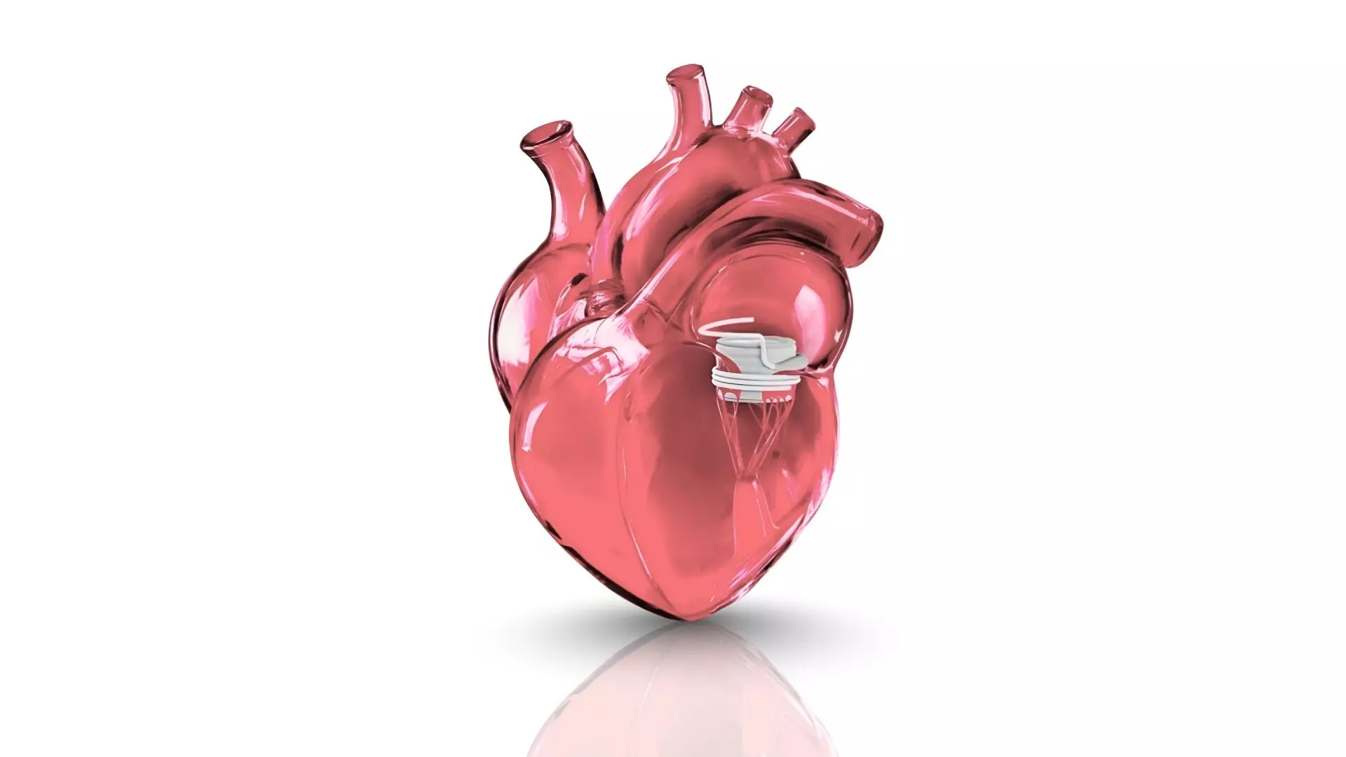 TCT 2025: One-Year ENCIRCLE Trial Outcomes Highlight Reduced Mortality and Heart Failure (HF) Admissions with Transcatheter Mitral Valve Replacement (TMVR) Using SAPIEN M3 System