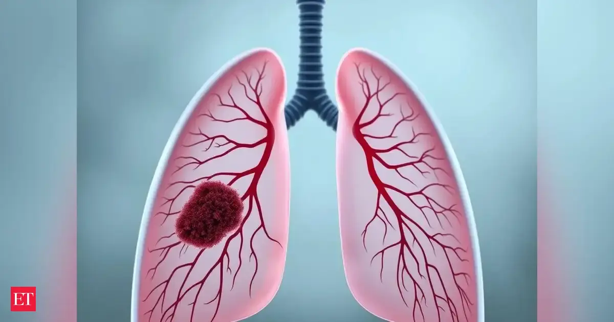 Lung cancer alert: Doctors say it’s not just for smokers — watch for these early symptoms