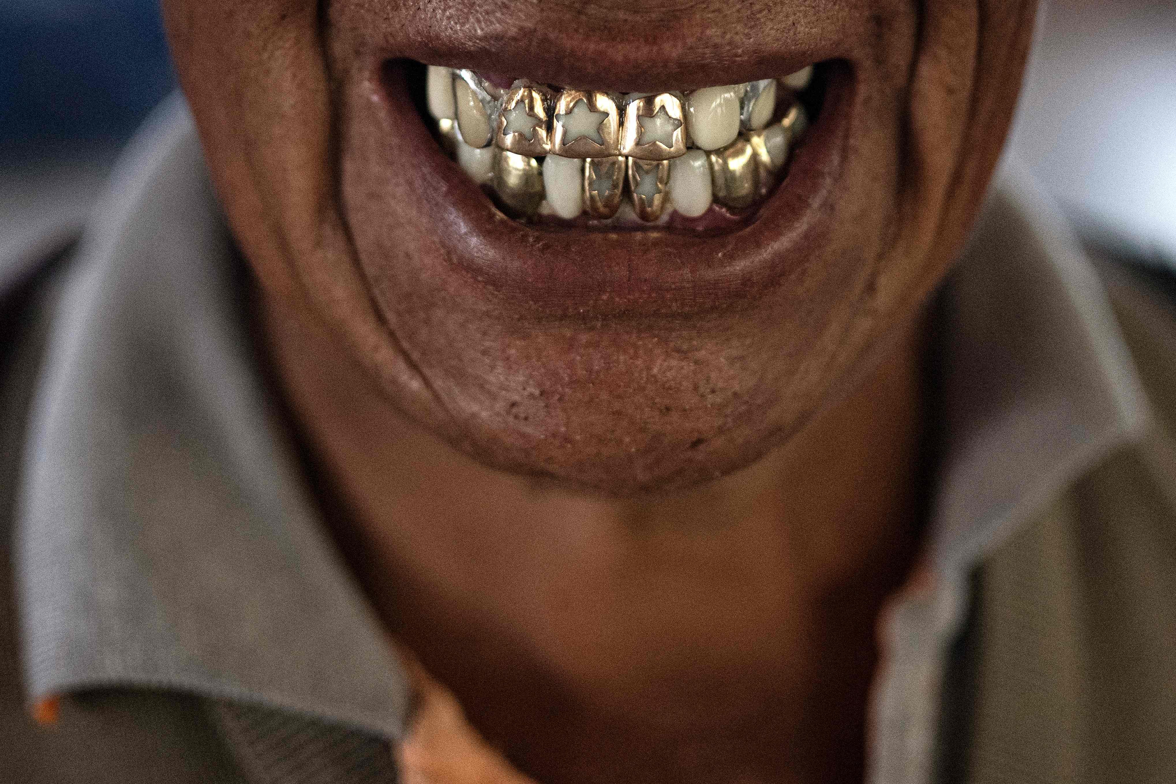 No more mercury in your mouth: toxic metal’s use as tooth filling to end by 2034
