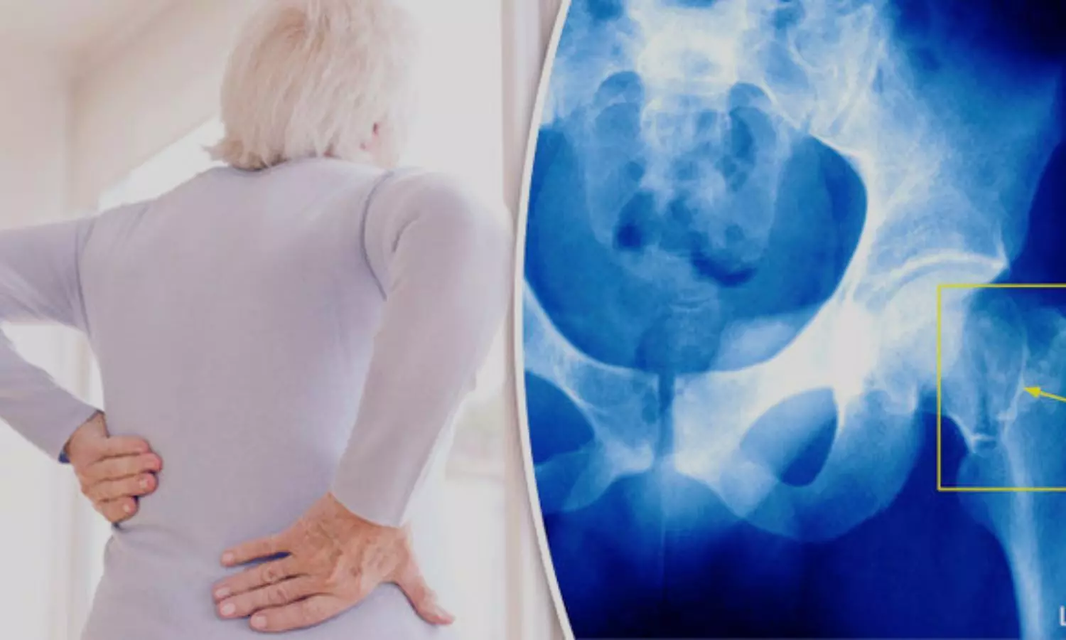Few Older Adults Receive Osteoporosis Medication After Hip Fracture, Study Shows