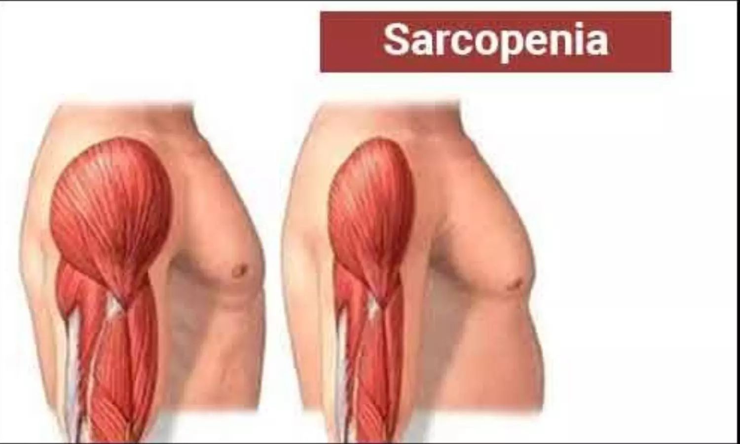 Sarcopenia Emerges as Strong Predictor of Mortality in Cardiovascular-Kidney-Metabolic Syndrome: Study