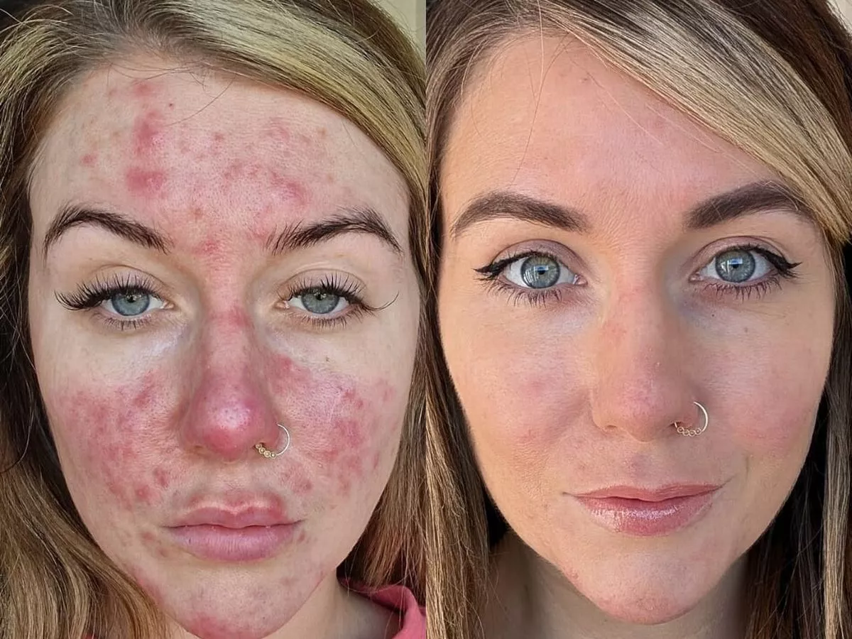 'My skin condition made me look like I was sunburnt - it ruined my confidence'
