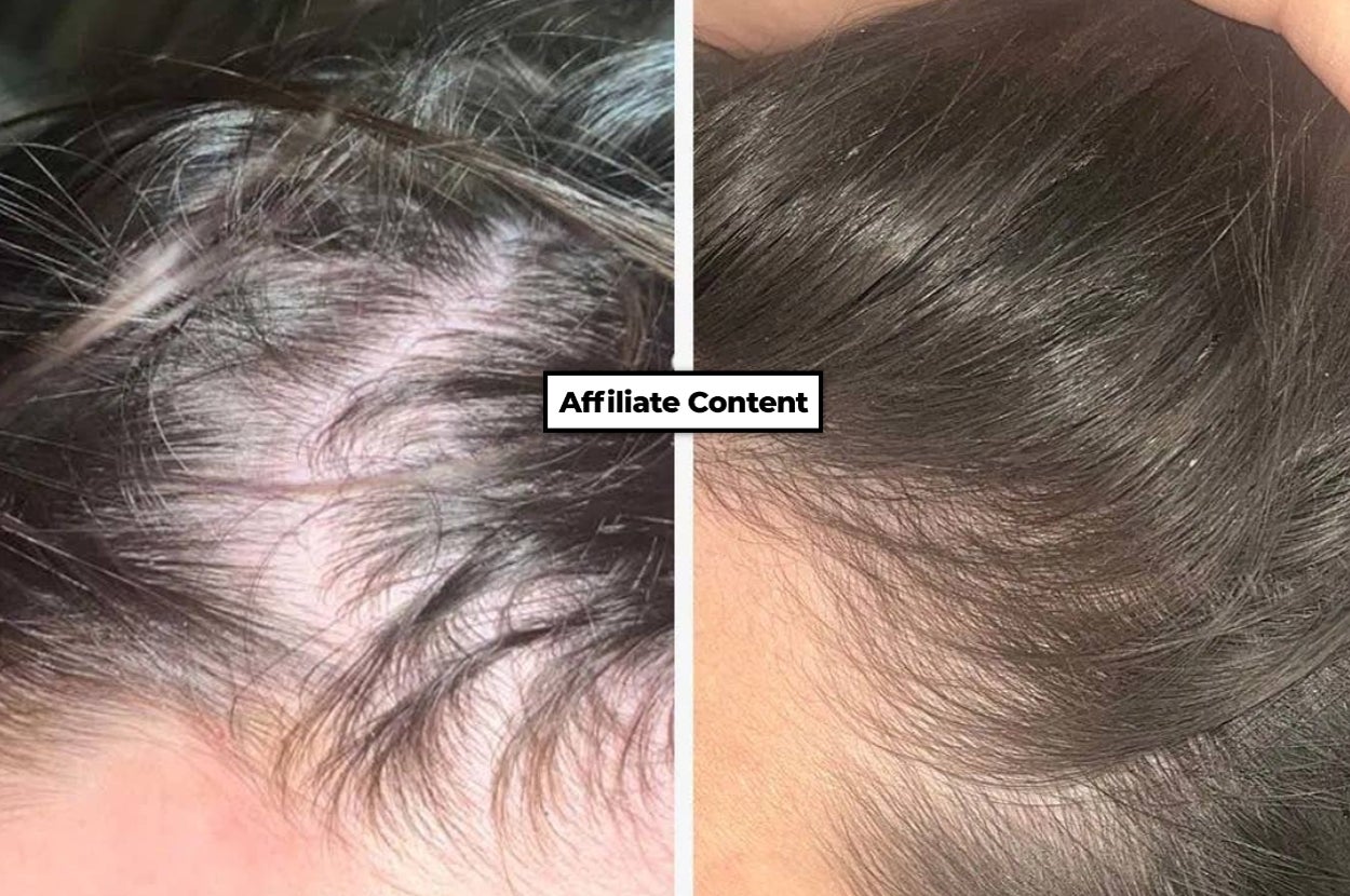 Experts Swear By This "Magic" Supplement For Thinning Hair, And Looking At The Before And After Photos I Can See Why