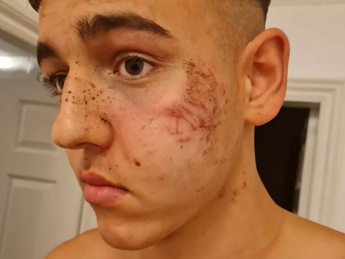 'My life got flipped upside down' - Teen rugby star's career in tatters after rival player kicks him in face