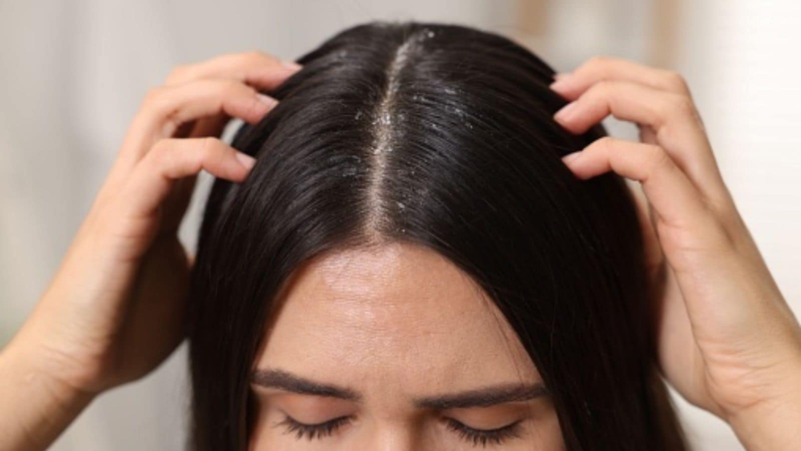 Flaky Scalp and Dandruff Season: A Dermatologist’s Guide to a Healthy Winter Scalp