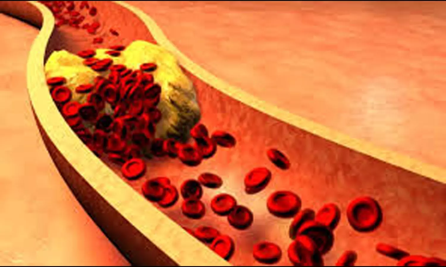 TyG-BMI Index Predicts Higher Mortality Risk in Osteoporosis Patients: Study