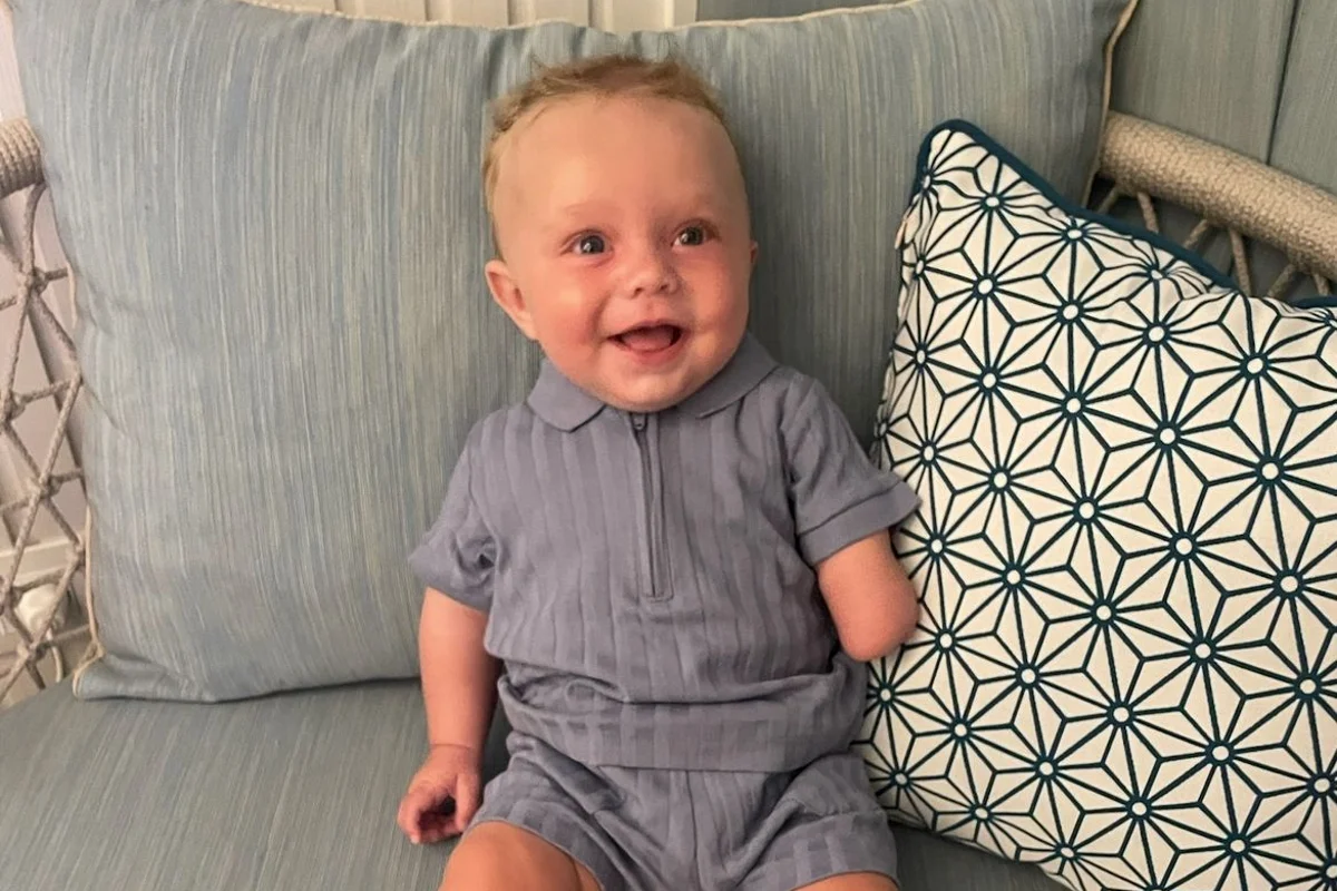 Baby boy’s hand severed in utero due to extremely rare condition