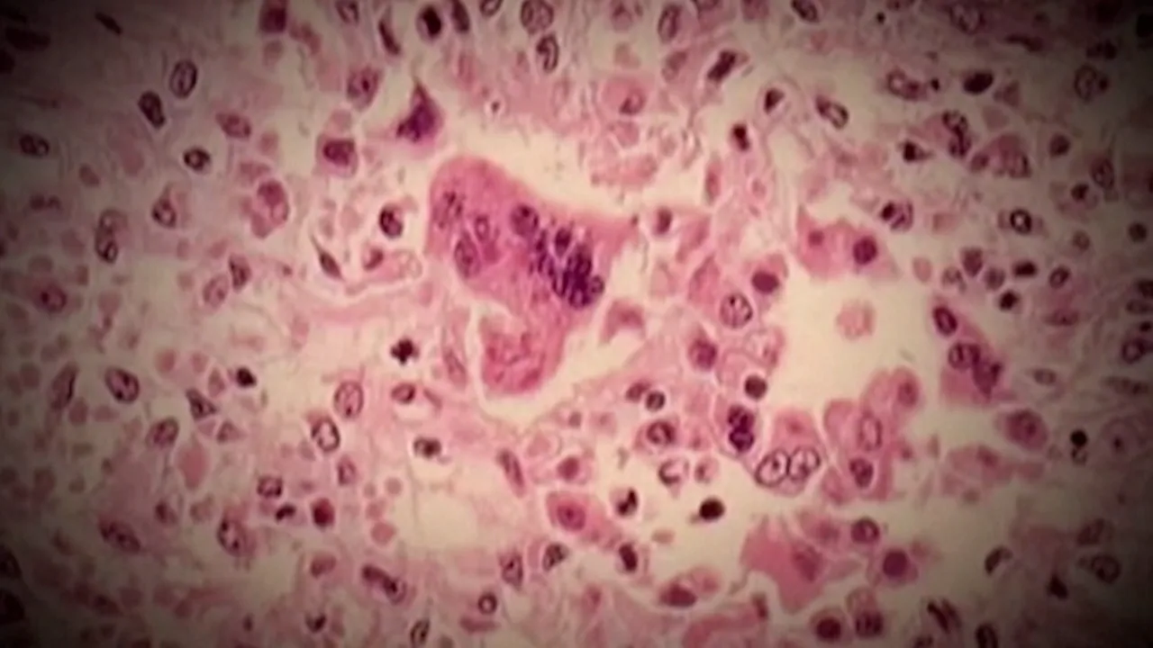 Canada loses measles elimination status