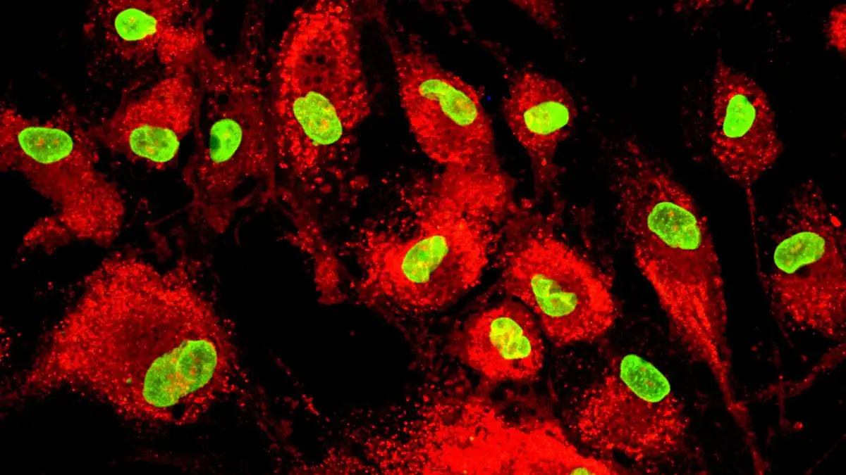 Stem cell therapy lowers risk of heart failure after a heart attack