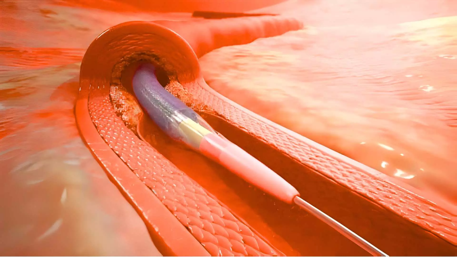 TCT 2025: REC-CAGEFREE I Trial Compares Drug-Coated Balloons (DCB) and Drug-Eluting Stents (DES) in De Novo Coronary Lesions