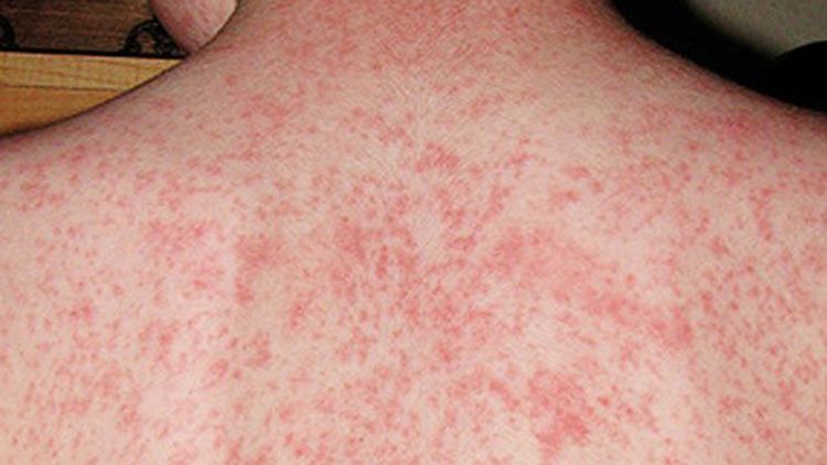 North American nation loses measles-free status as vaccination rates fall