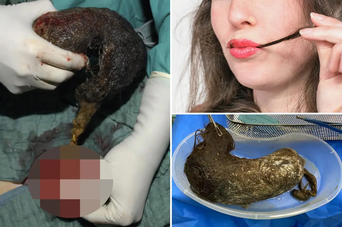 10-year-old girl has 10 oz. hairball removed from her stomach