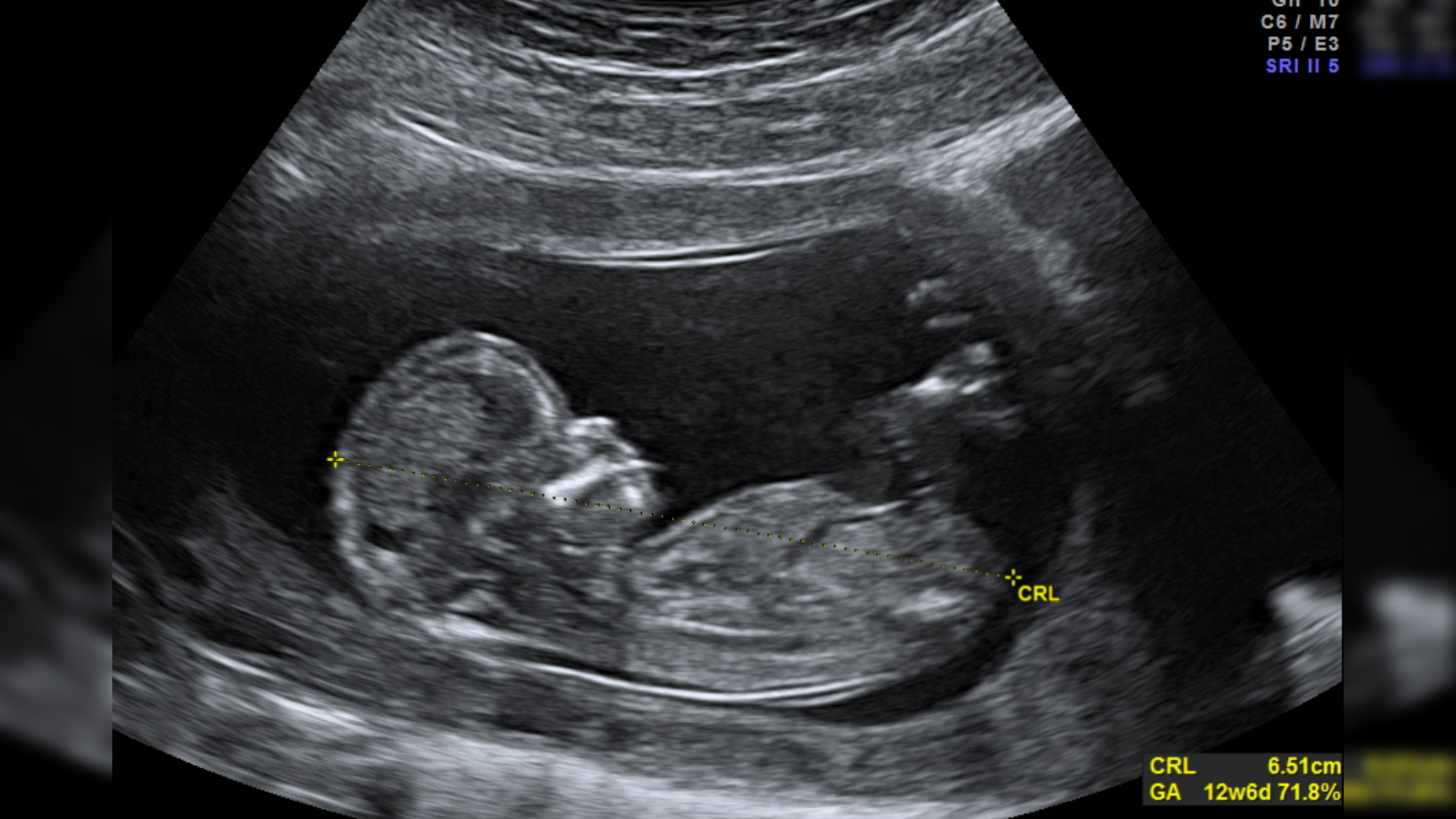 Legacy Media Ignores Study Showing Psychological Harm of Abortion